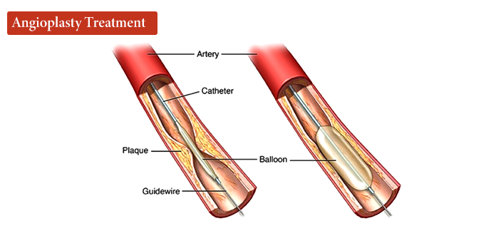 Angioplasty Treatment